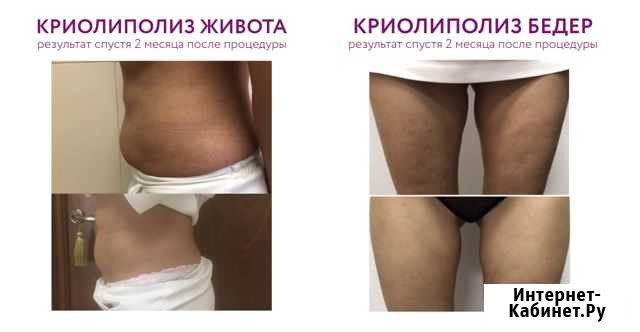 Криолиполиз Владимир - изображение 1