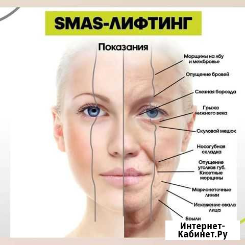 Smas лифтинг Псков Псков - изображение 1