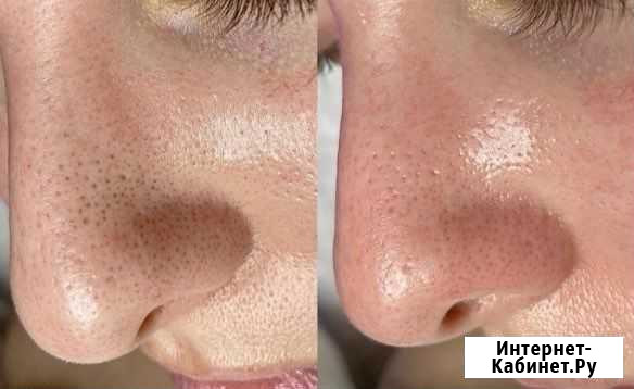 Чистка лица Набережные Челны - изображение 1