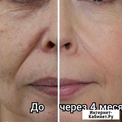 Холодная плазма Красноярск - изображение 1