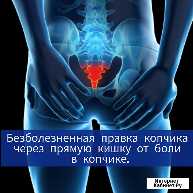 Правка копчика без боли и операции, кокцигодиния, боль в копчике лечение Москва - изображение 1
